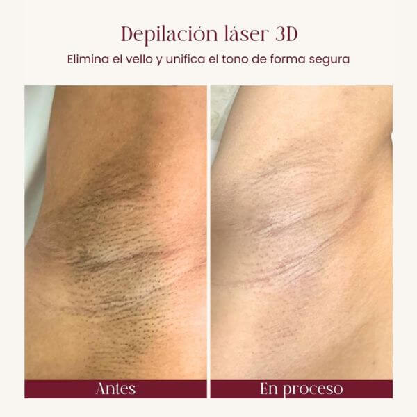 Laser hair removal
