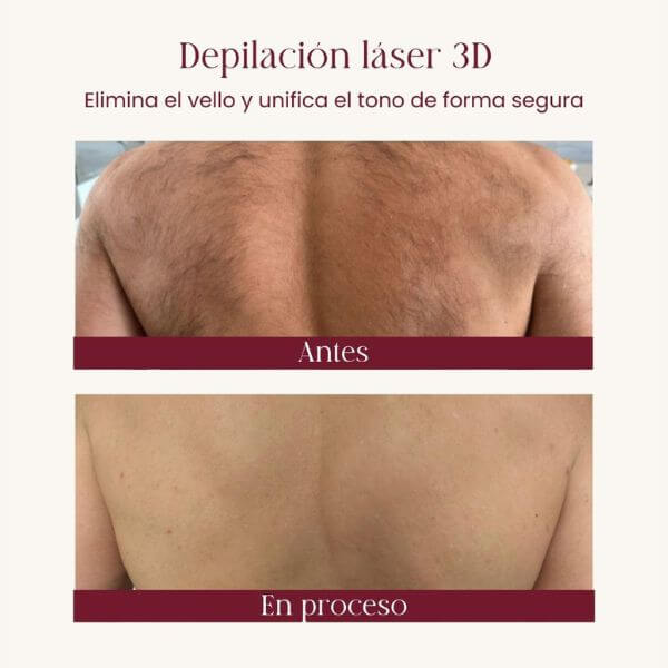 Laser hair removal