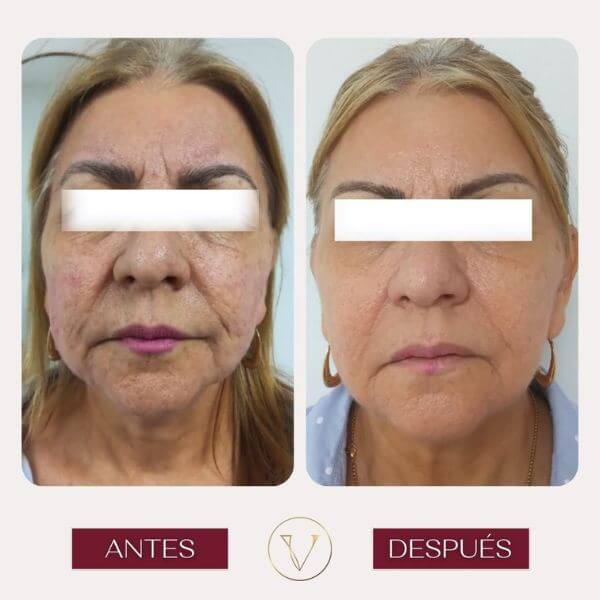 Facial rejuvenation