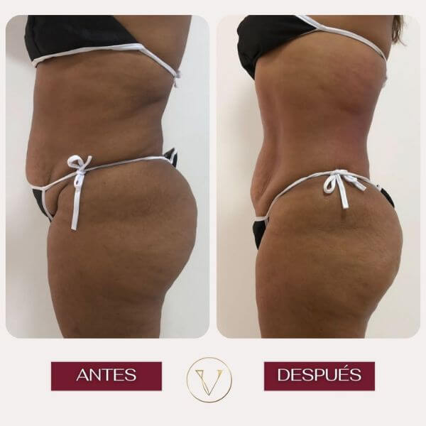 Body contouring treatment