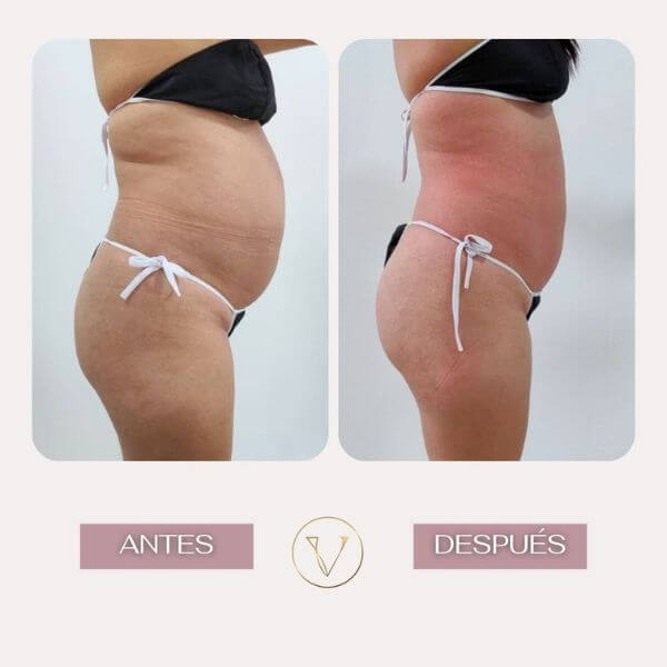 Body contouring treatment