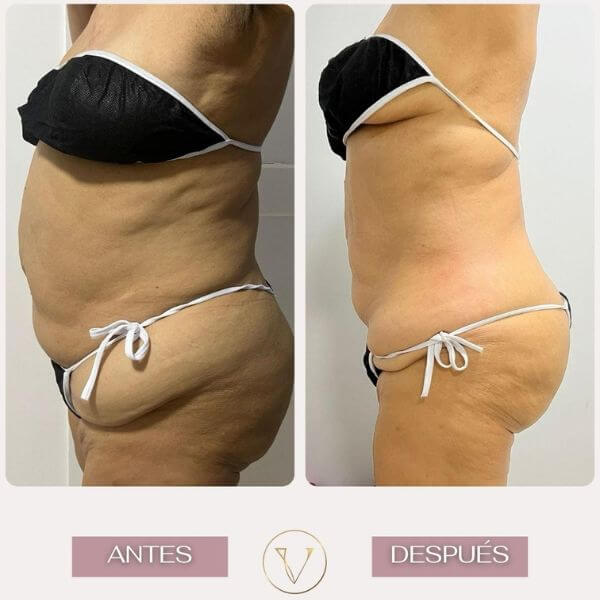 Body contouring treatment