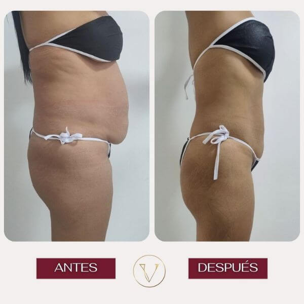 Body contouring treatment