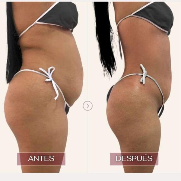 Body contouring treatment
