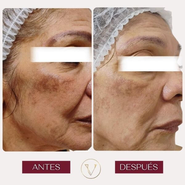 Dark spots