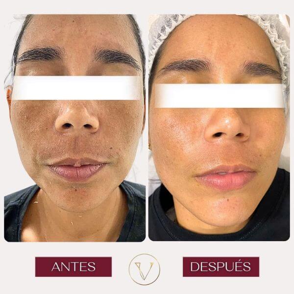 Dark spots