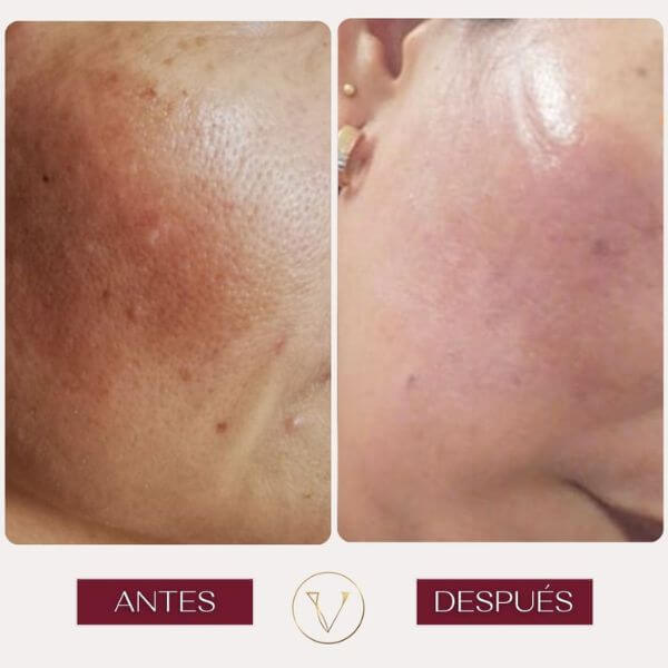 Dark spots