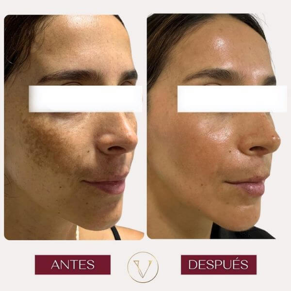Dark spots