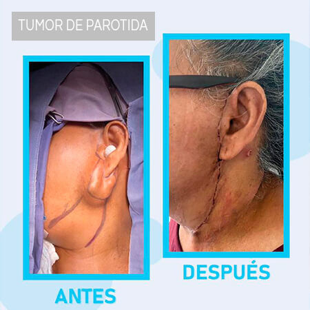 Tumores
