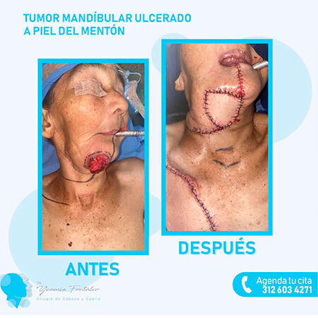 Tumores
