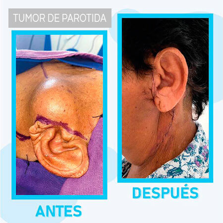 Tumores