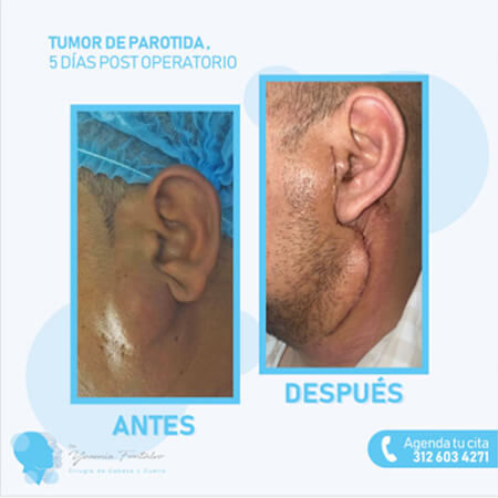 Tumores