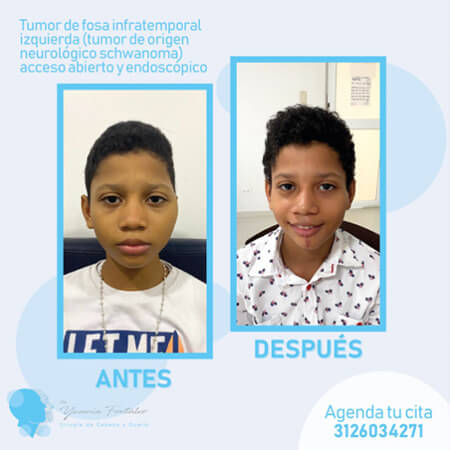 Tumores