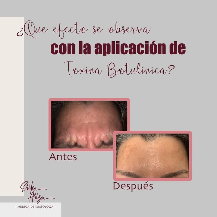 Toxina botulínica