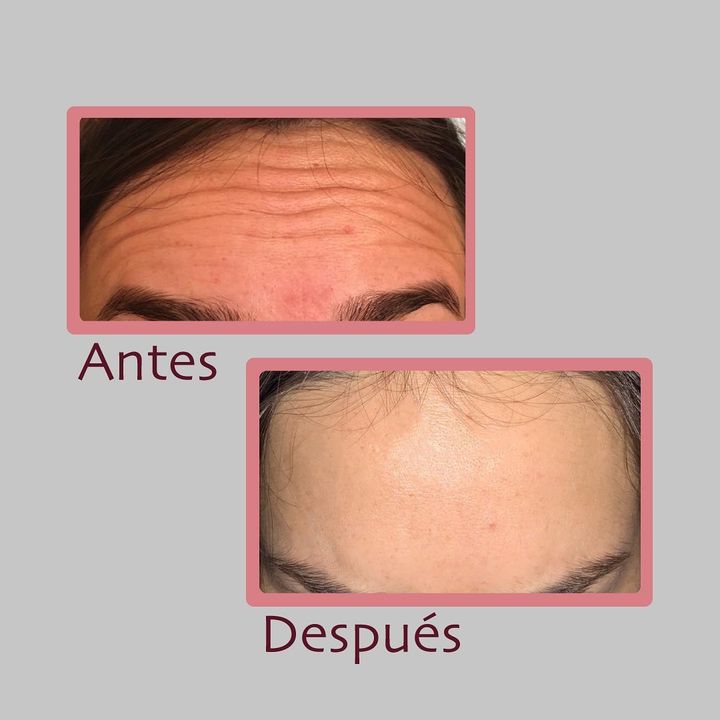 Toxina botulínica