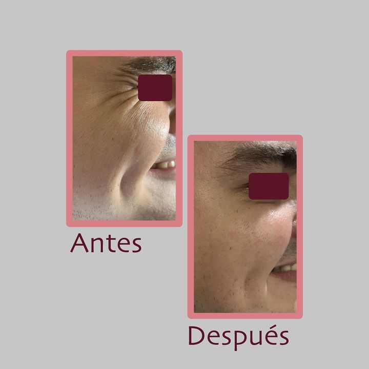Toxina botulínica
