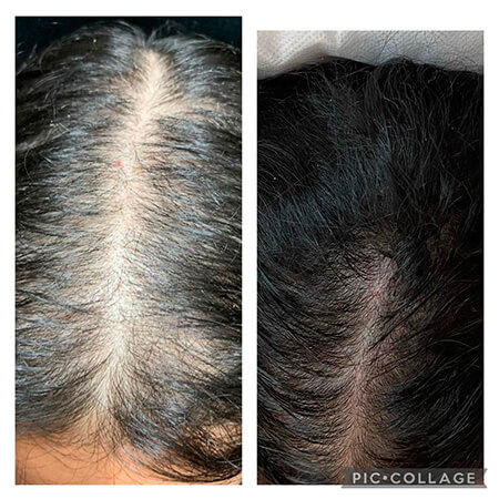 Alopecia