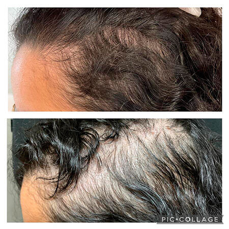 Alopecia