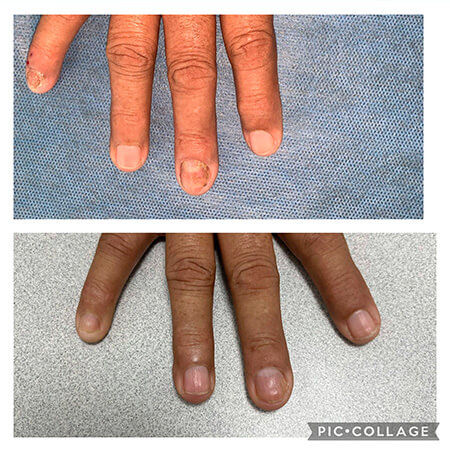 Tratamiento para uñas