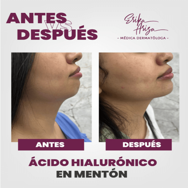 Corrección de mentón sin cirugía