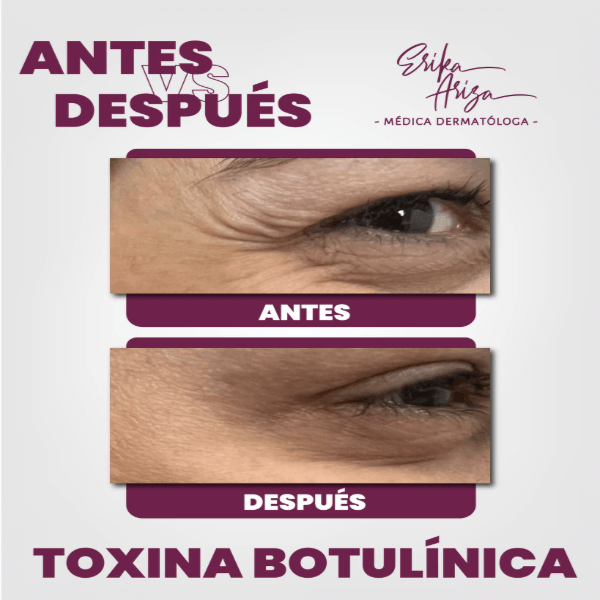 Toxina botulínica