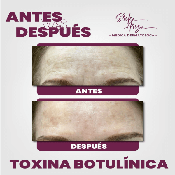 Toxina botulínica