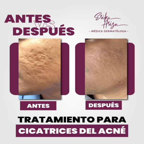 Cicatrices