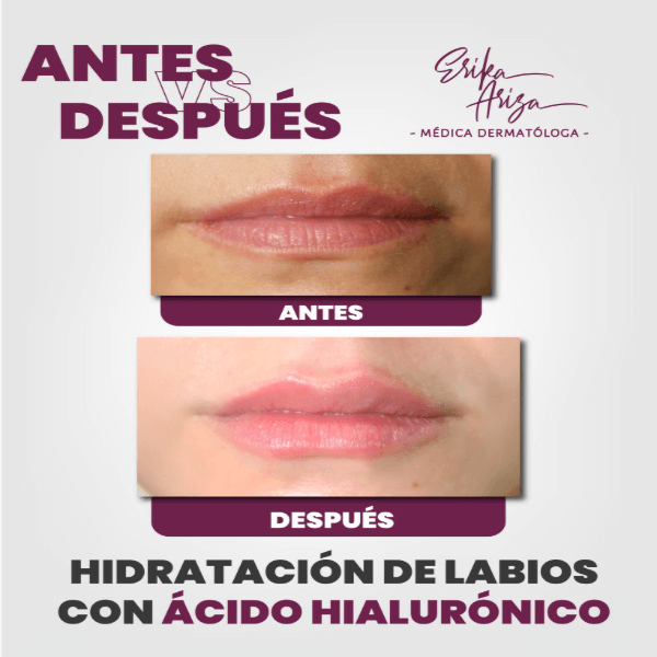 Aumento de labios