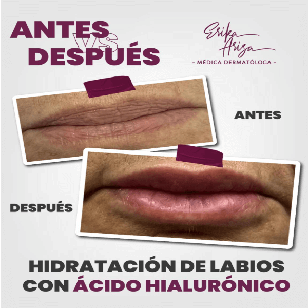 Aumento de labios