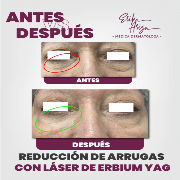 Arrugas