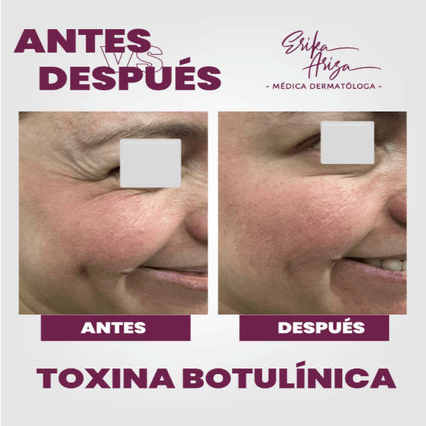 Toxina botulínica