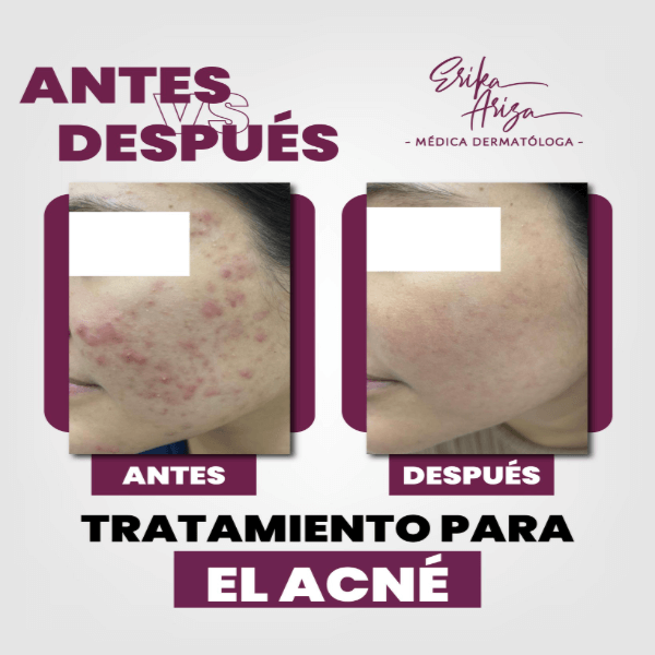 Acné