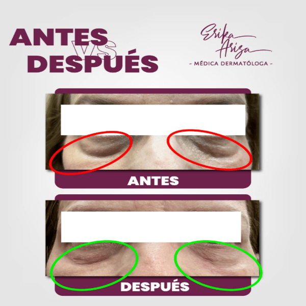 Ojeras