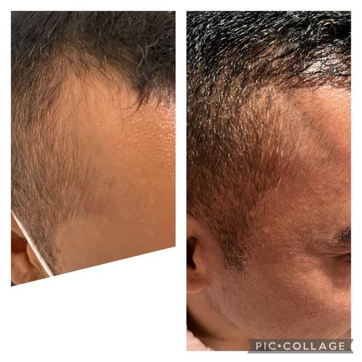 Alopecia