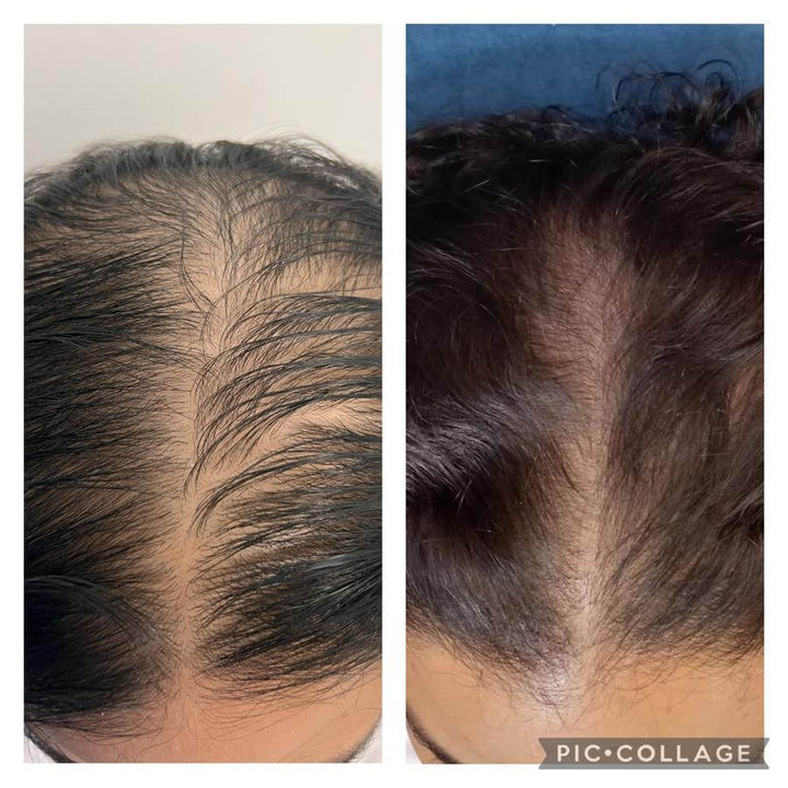 Alopecia