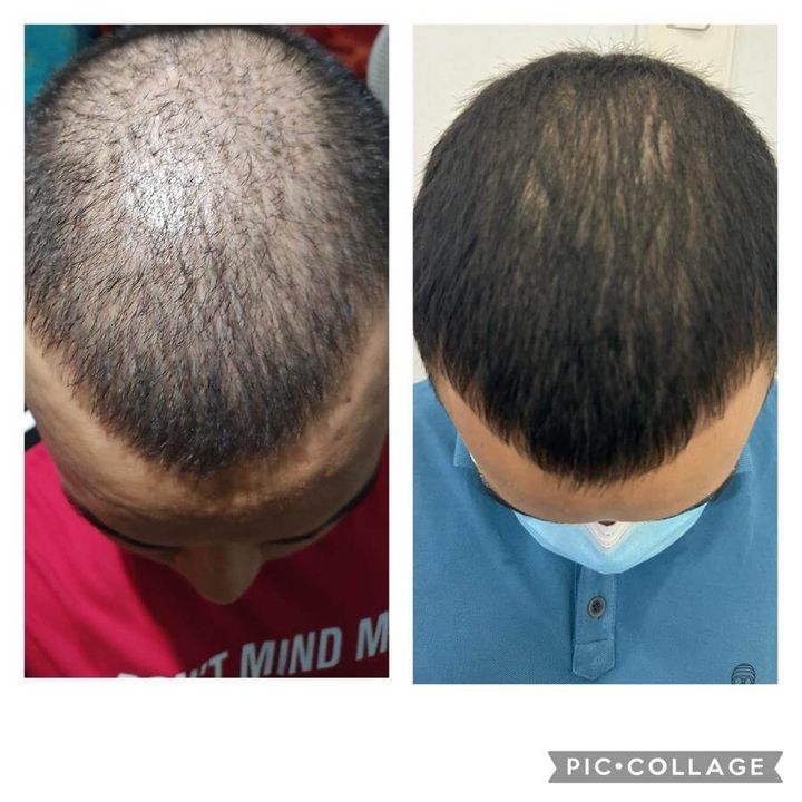 Alopecia