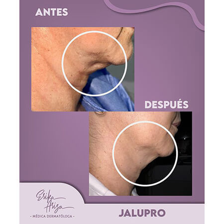 Corrección de papada sin cirugía
