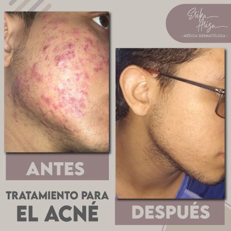 Acné