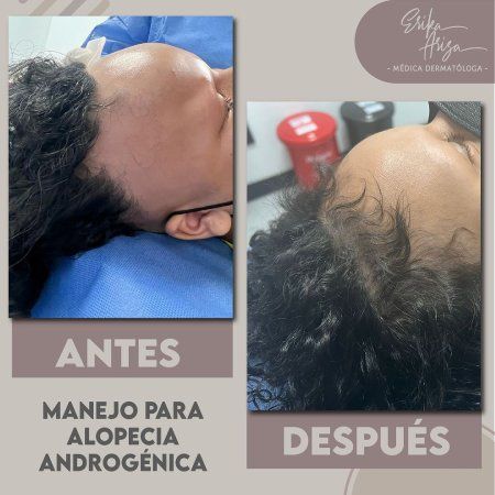 Alopecia