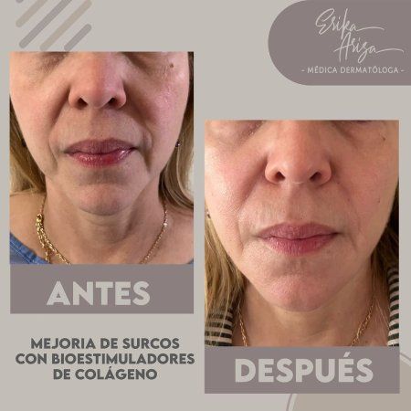 Bioestimulador de colágeno