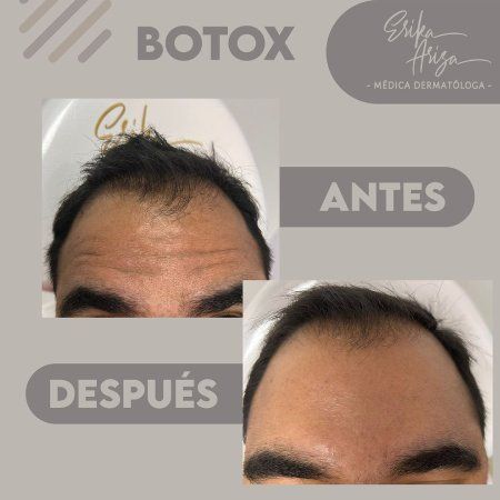 Toxina botulínica