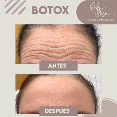 Toxina botulínica
