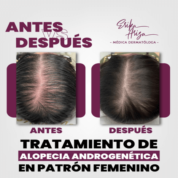 Alopecia