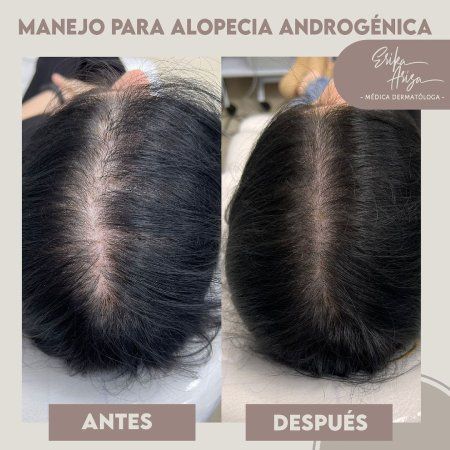 Alopecia