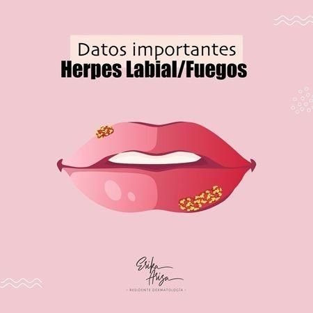 Herpes labial 