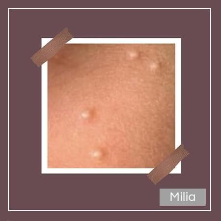  Milia