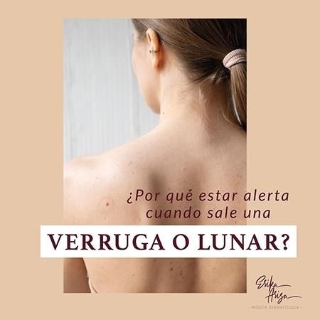 Verruga o lunar 
