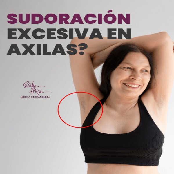 Sudoración excesiva (hiperhidrosis) 