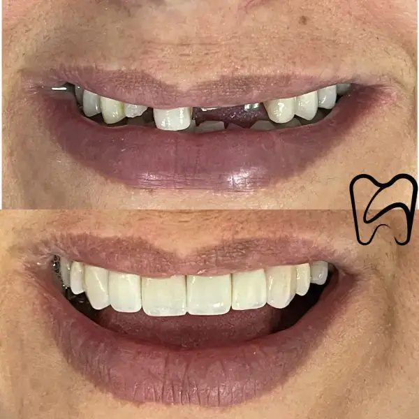 Dental implants
