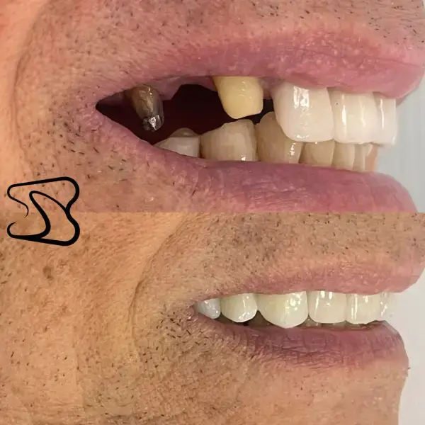 Dental crown